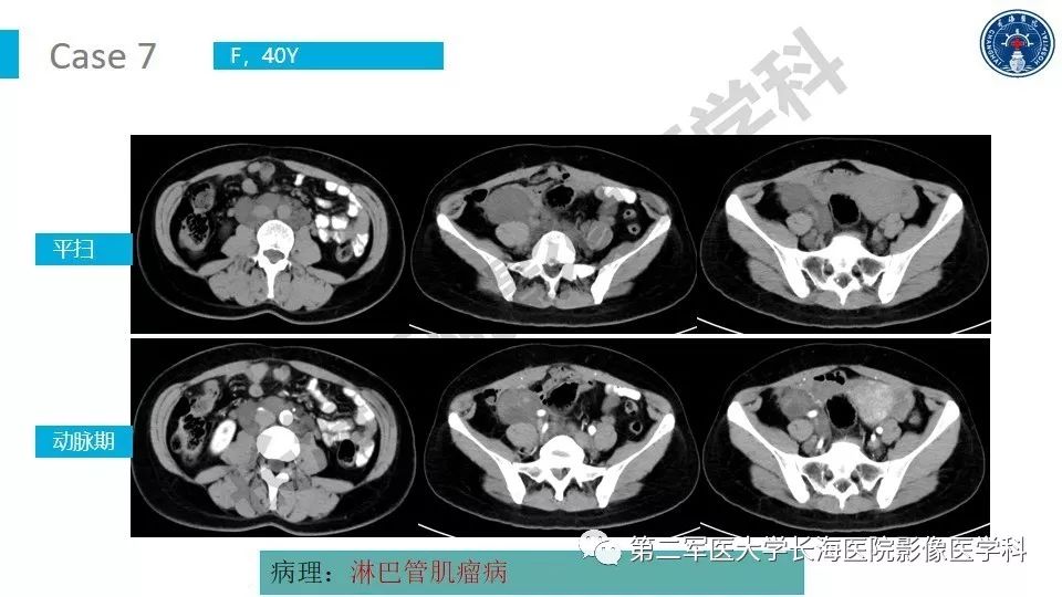 【PPT】原发性腹膜后囊性病变影像特征