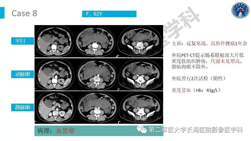 【PPT】原发性腹膜后囊性病变影像特征