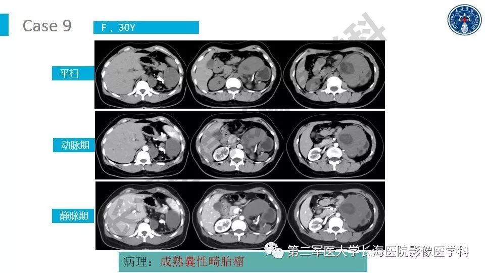 【PPT】原发性腹膜后囊性病变影像特征