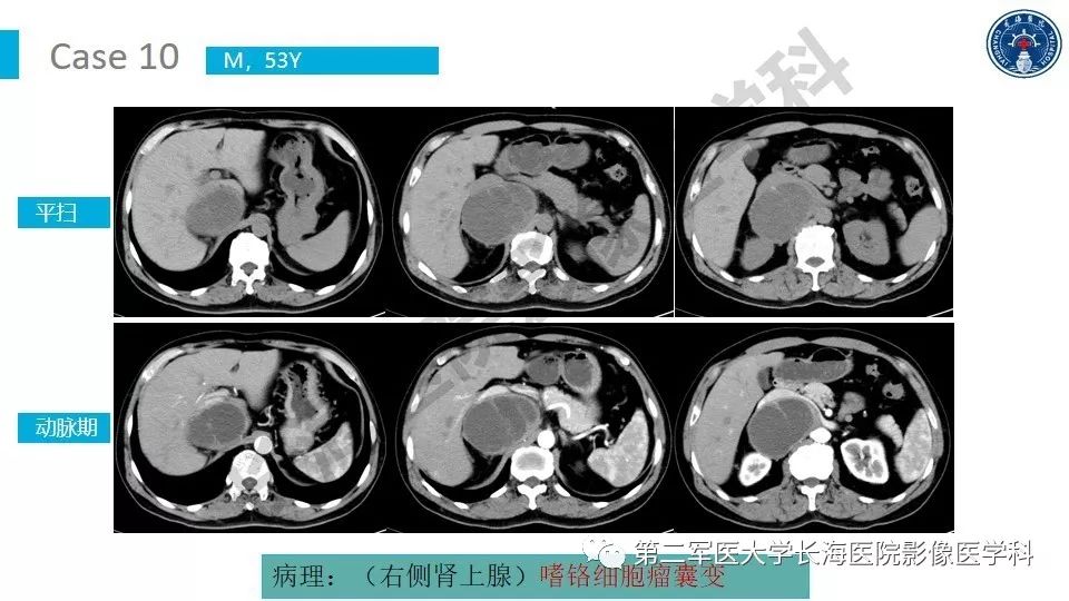 【PPT】原发性腹膜后囊性病变影像特征