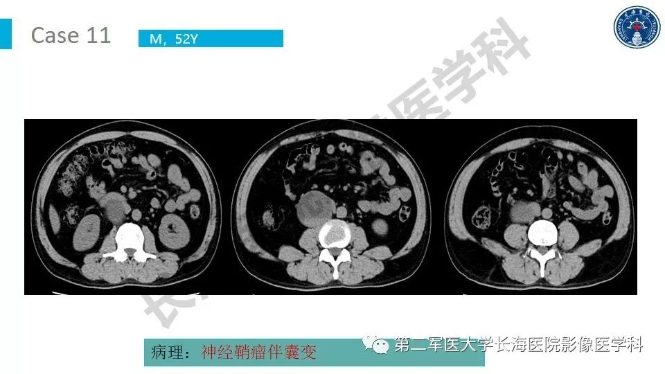 【PPT】原发性腹膜后囊性病变影像特征