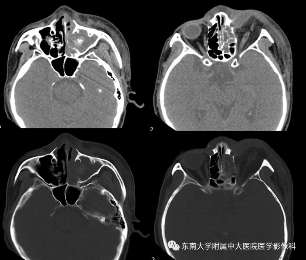 【病例】真菌性鼻窦炎1例CT影像