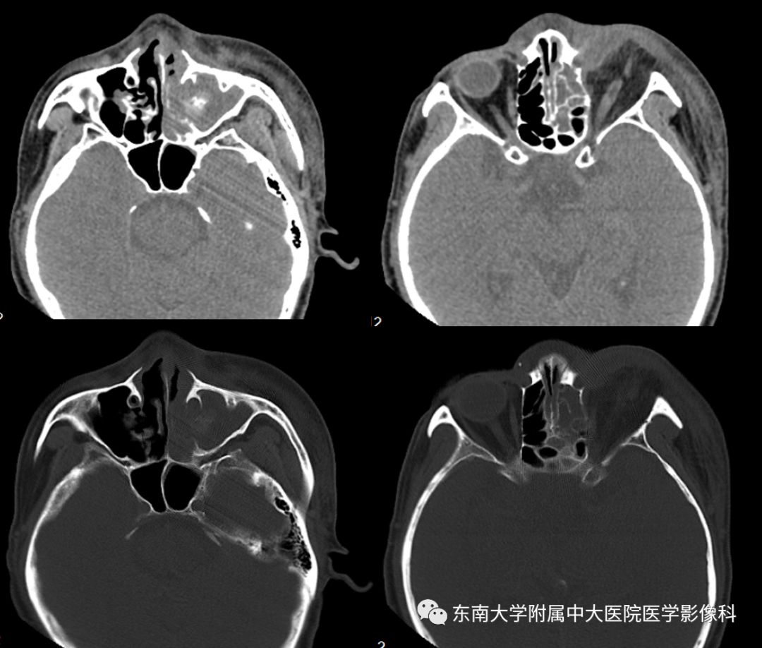 【病例】真菌性鼻窦炎1例CT影像