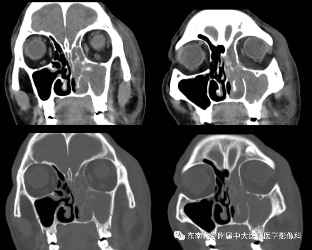 【病例】真菌性鼻窦炎1例CT影像