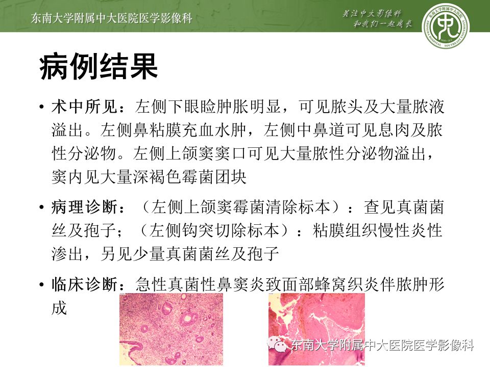 【病例】真菌性鼻窦炎1例CT影像