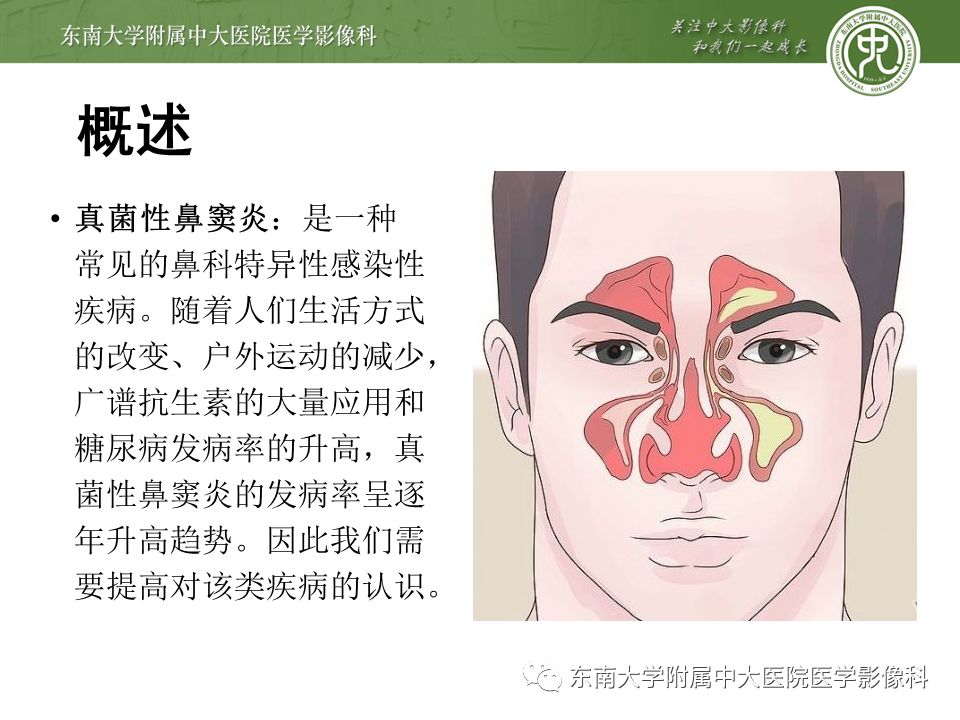 【病例】真菌性鼻窦炎1例CT影像