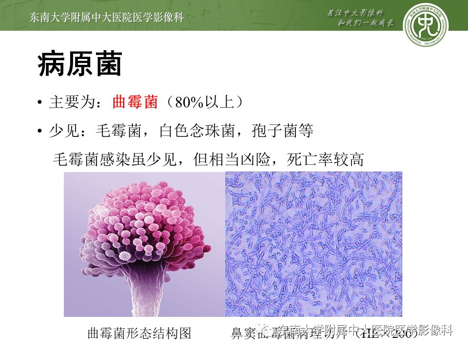 【病例】真菌性鼻窦炎1例CT影像