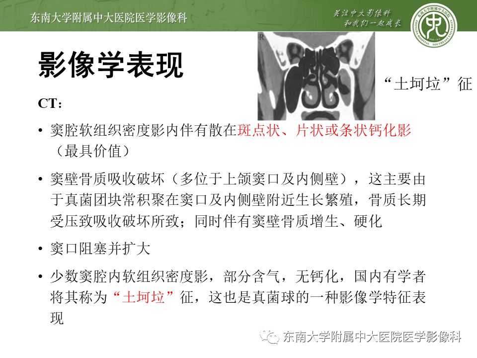 【病例】真菌性鼻窦炎1例CT影像
