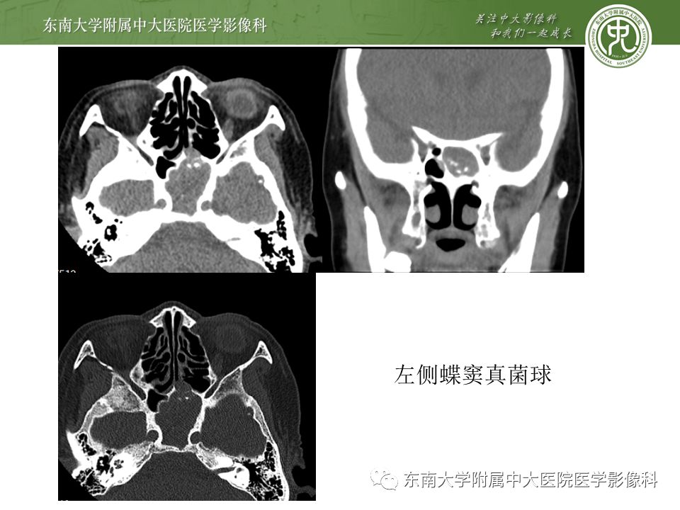 【病例】真菌性鼻窦炎1例CT影像