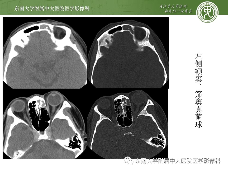 【病例】真菌性鼻窦炎1例CT影像