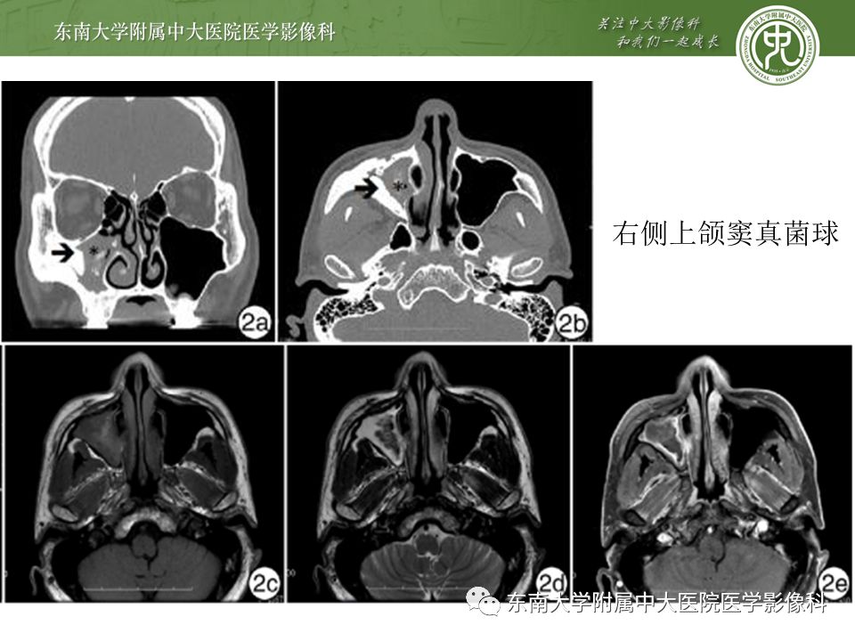【病例】真菌性鼻窦炎1例CT影像