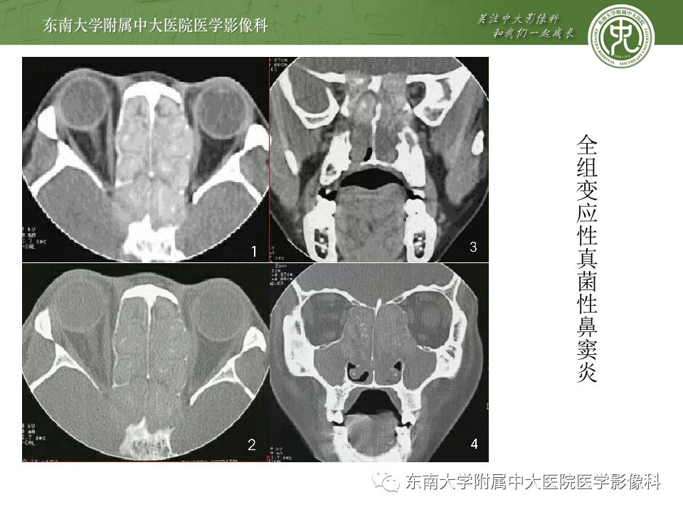 【病例】真菌性鼻窦炎1例CT影像