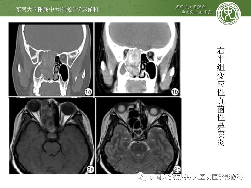【病例】真菌性鼻窦炎1例CT影像