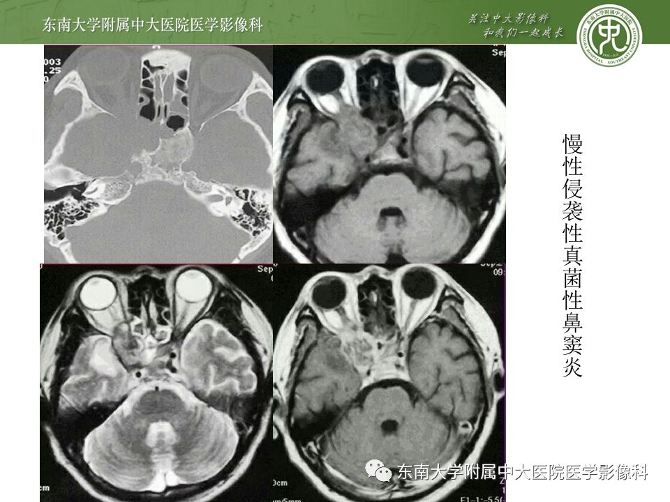 【病例】真菌性鼻窦炎1例CT影像