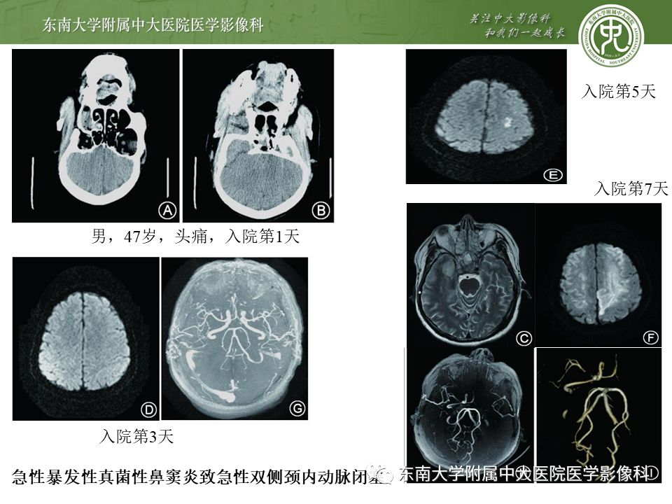 【病例】真菌性鼻窦炎1例CT影像