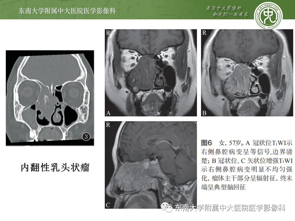【病例】真菌性鼻窦炎1例CT影像