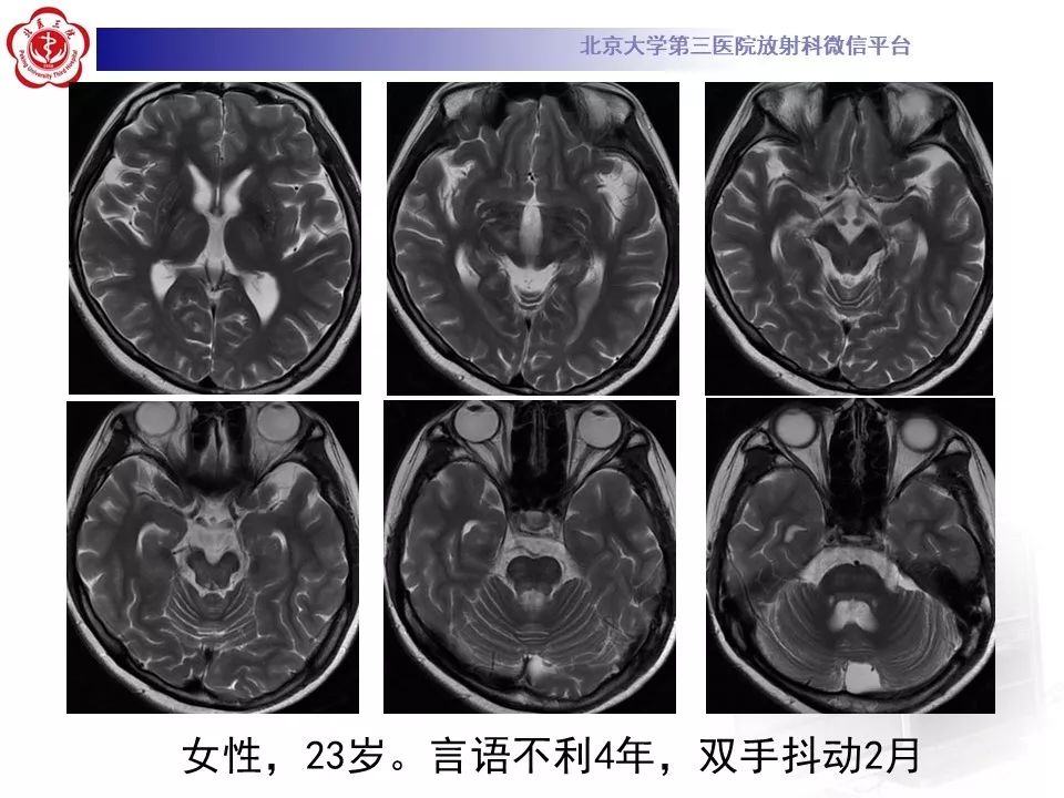 【病例】肝豆状核变性1例MR