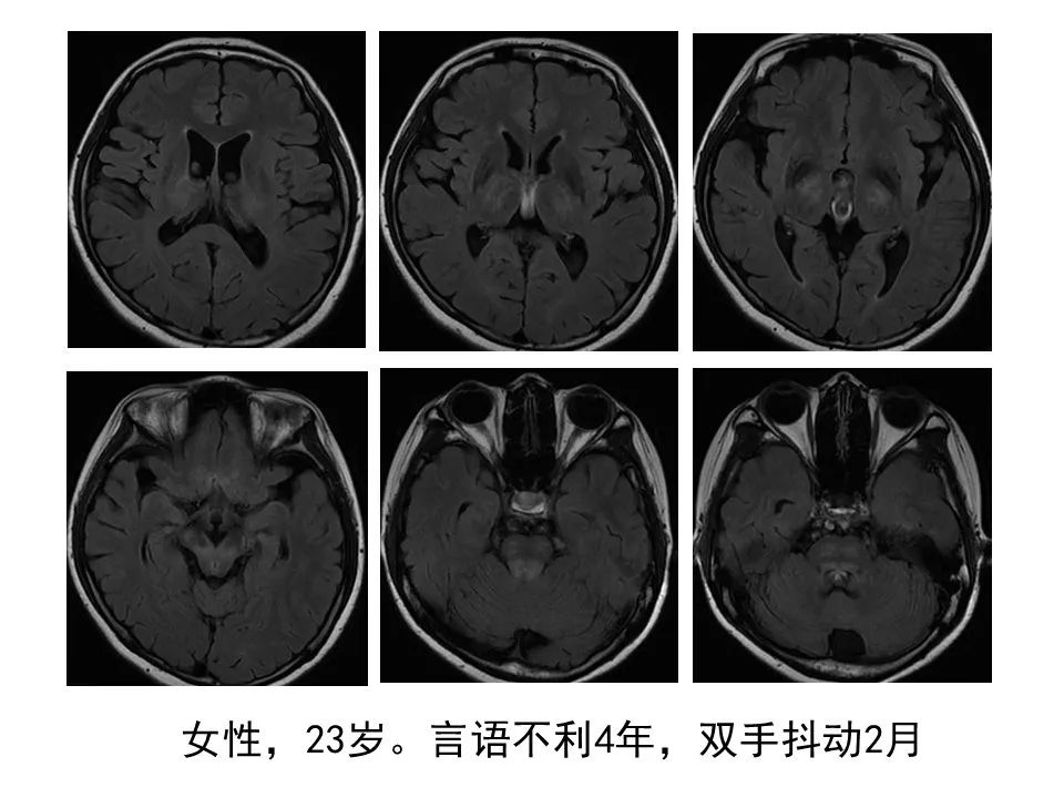 【病例】肝豆状核变性1例MR