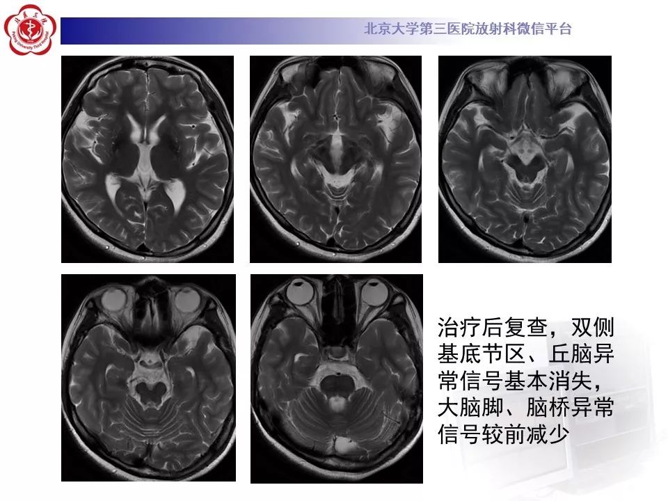【病例】肝豆状核变性1例MR