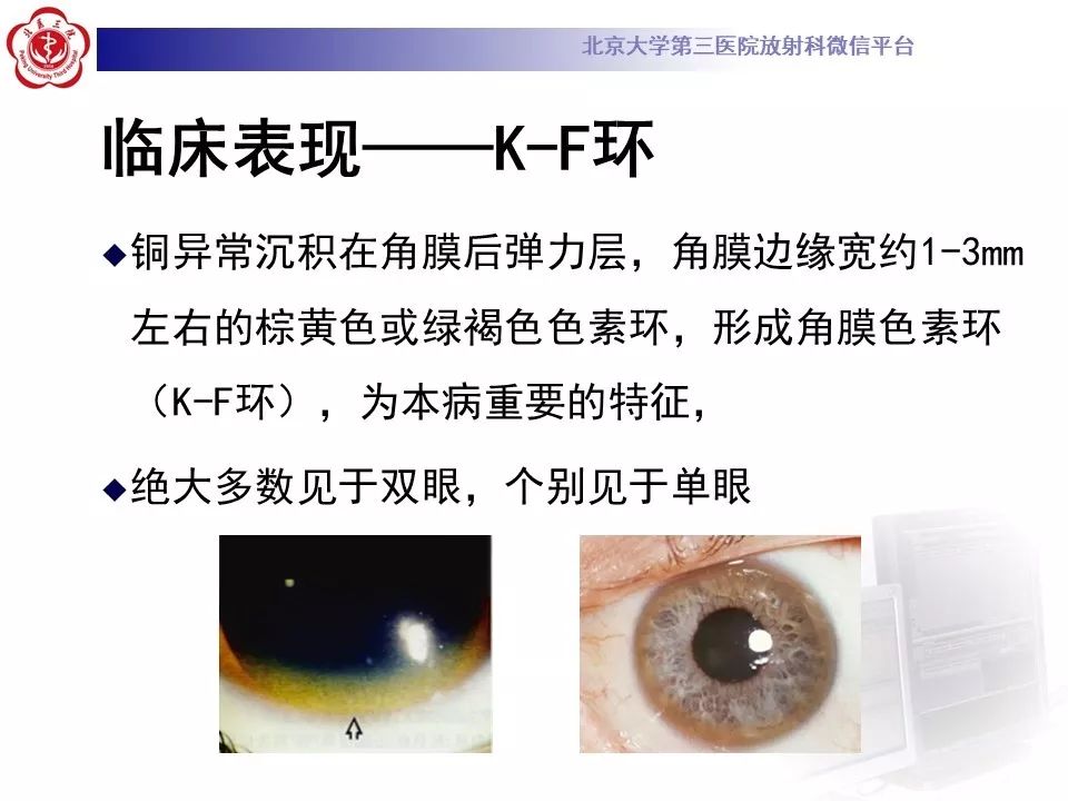 【病例】肝豆状核变性1例MR