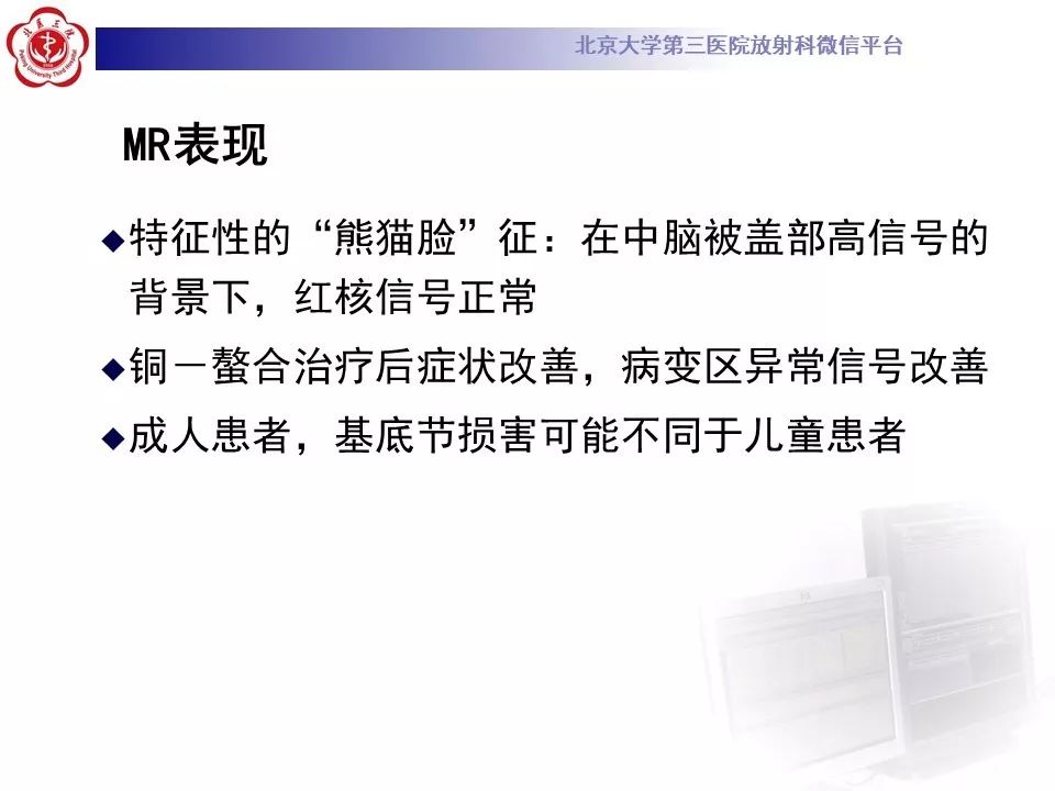 【病例】肝豆状核变性1例MR