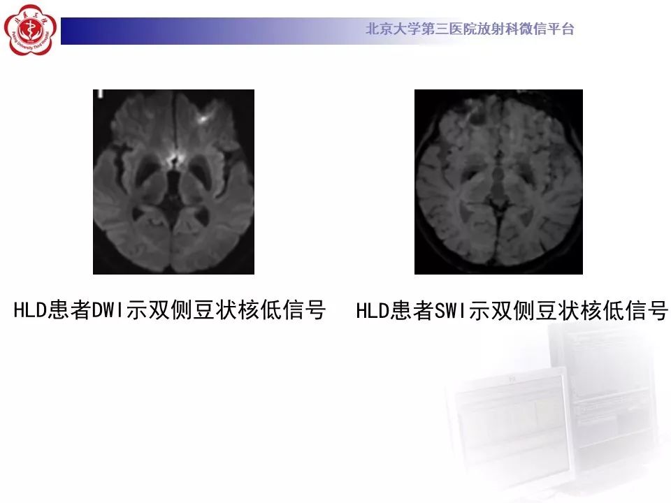 【病例】肝豆状核变性1例MR