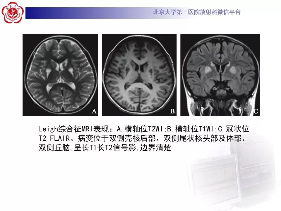【病例】肝豆状核变性1例MR