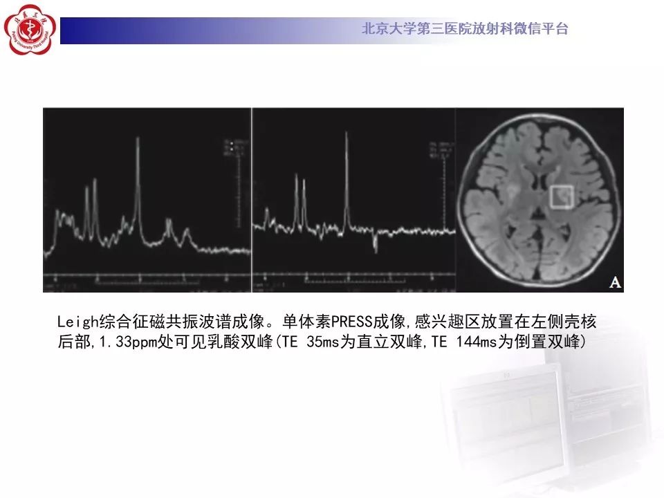 【病例】肝豆状核变性1例MR