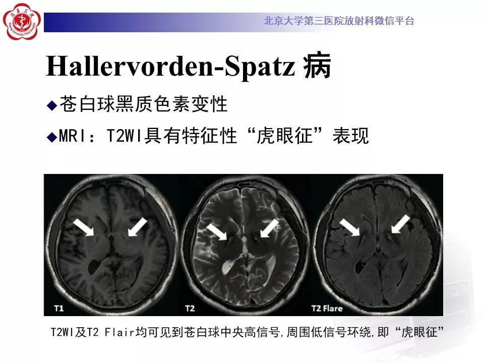 【病例】肝豆状核变性1例MR