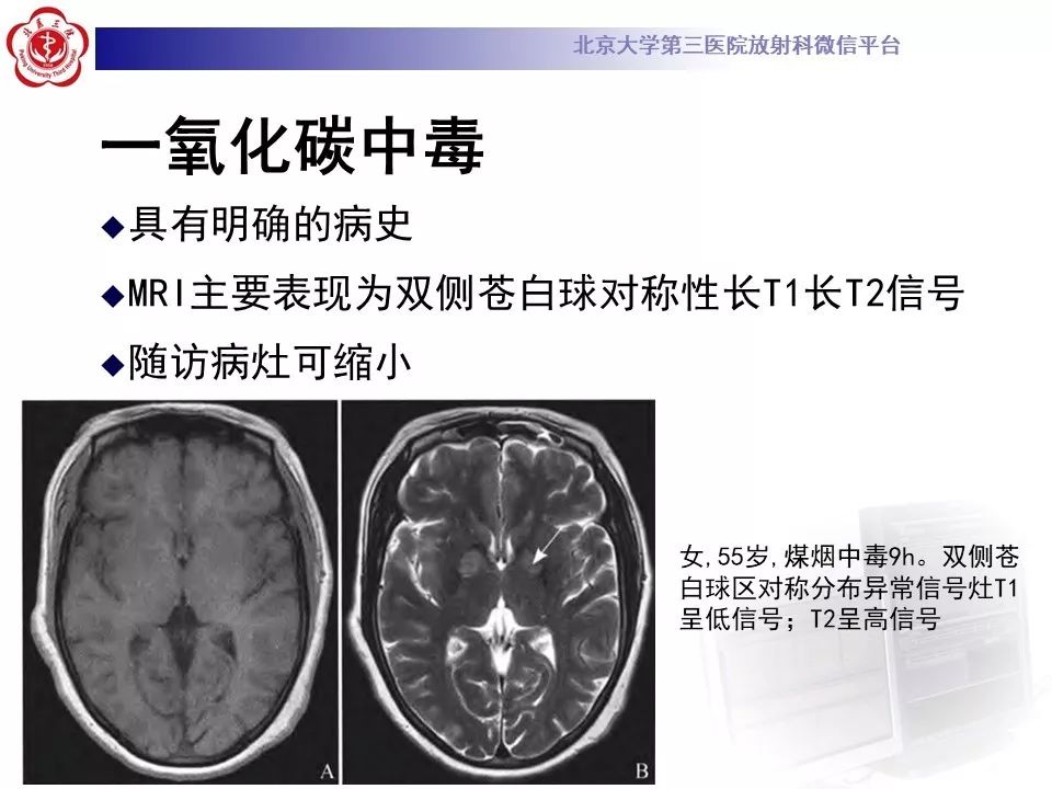 【病例】肝豆状核变性1例MR
