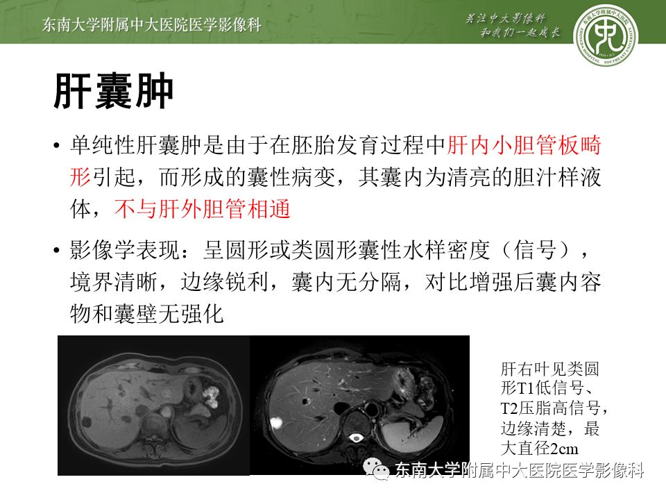 【病例】先天性肝囊性疾病2例CT影像