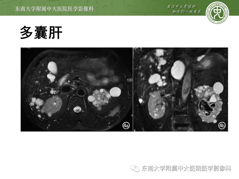 【病例】先天性肝囊性疾病2例CT影像