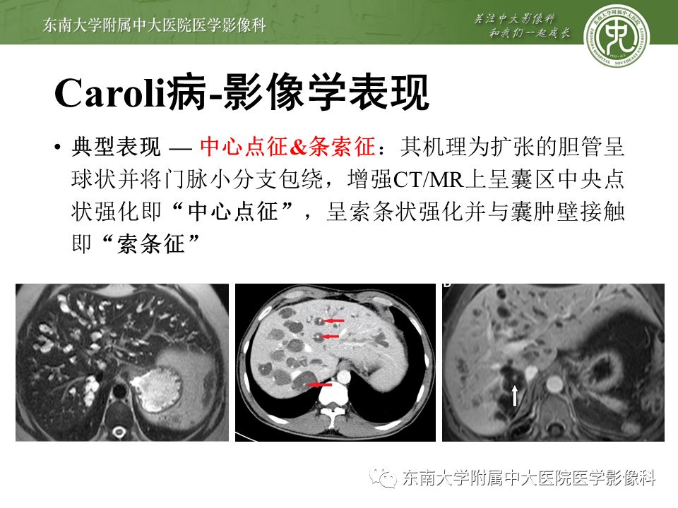 【病例】先天性肝囊性疾病2例CT影像