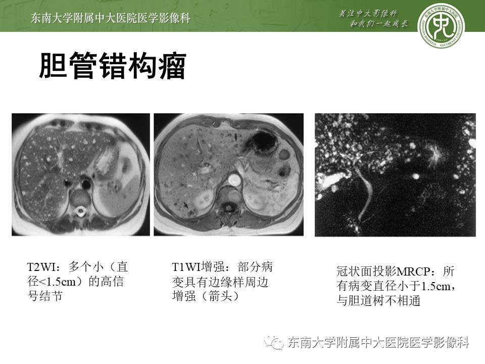 【病例】先天性肝囊性疾病2例CT影像