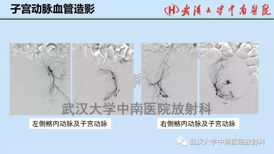 【PPT】女性生殖系统影像解剖及子宫常见疾病