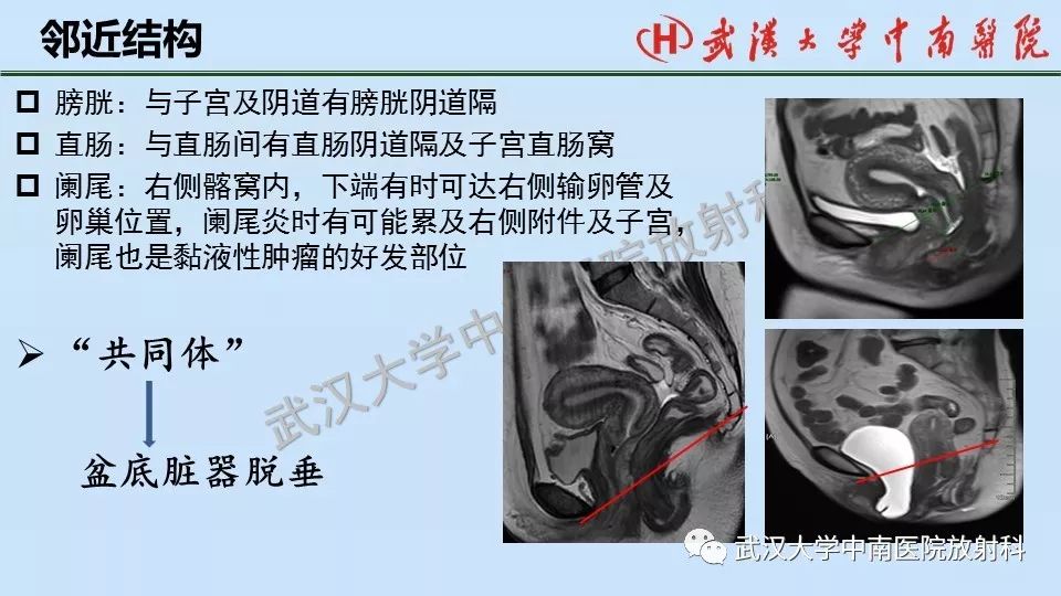 【PPT】女性生殖系统影像解剖及子宫常见疾病