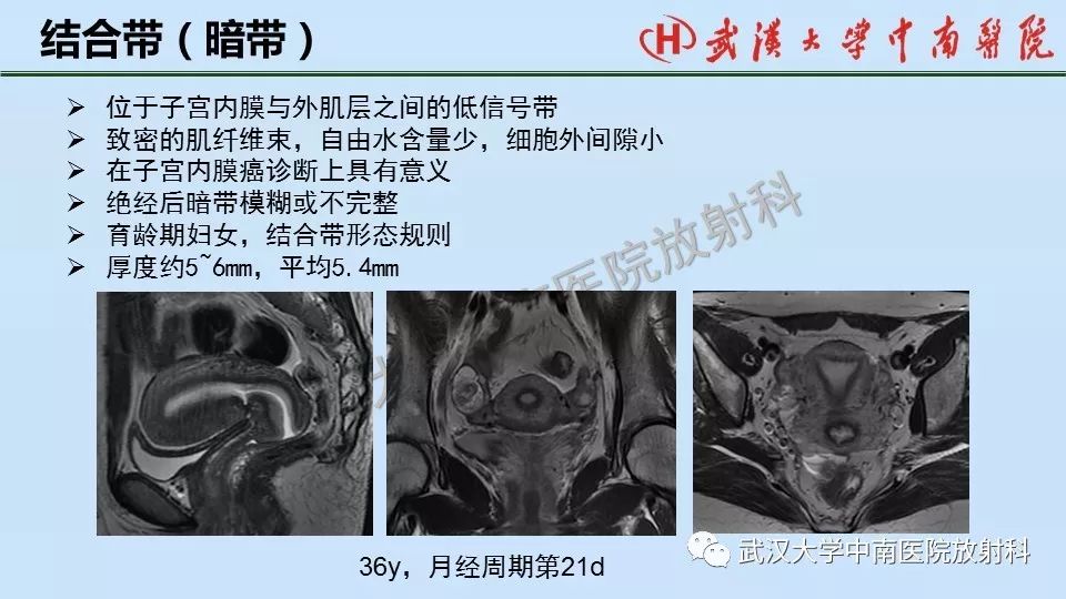 【PPT】女性生殖系统影像解剖及子宫常见疾病