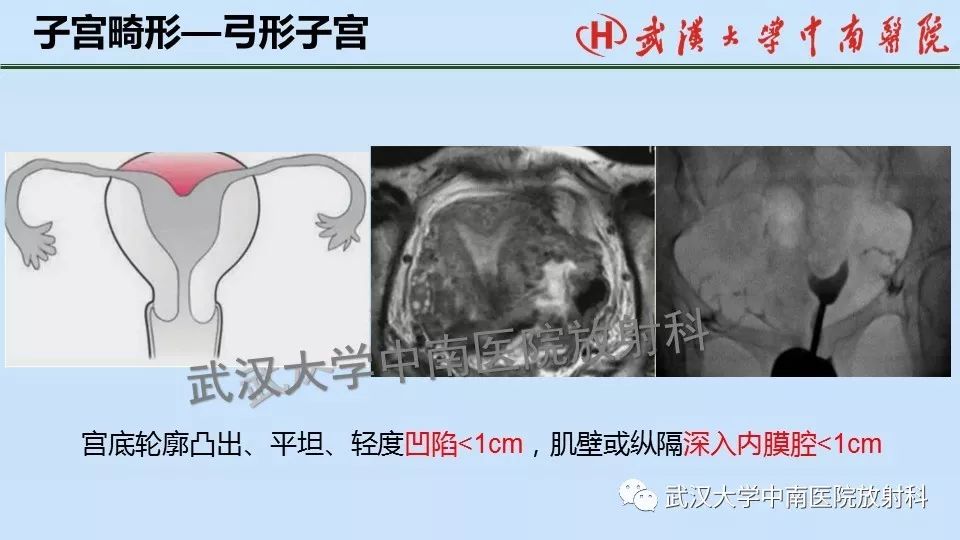 【PPT】女性生殖系统影像解剖及子宫常见疾病