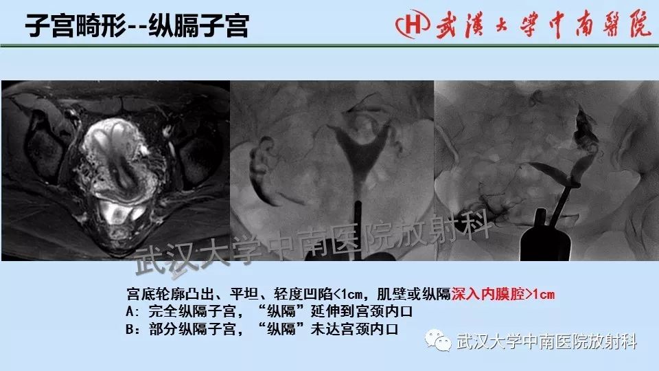 【PPT】女性生殖系统影像解剖及子宫常见疾病