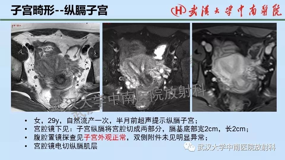 【PPT】女性生殖系统影像解剖及子宫常见疾病