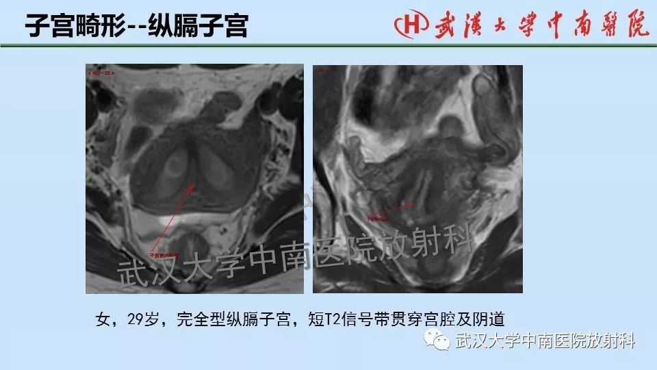 【PPT】女性生殖系统影像解剖及子宫常见疾病