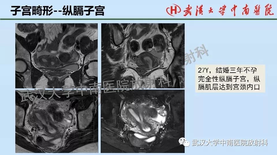 【PPT】女性生殖系统影像解剖及子宫常见疾病