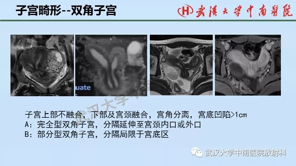 【PPT】女性生殖系统影像解剖及子宫常见疾病