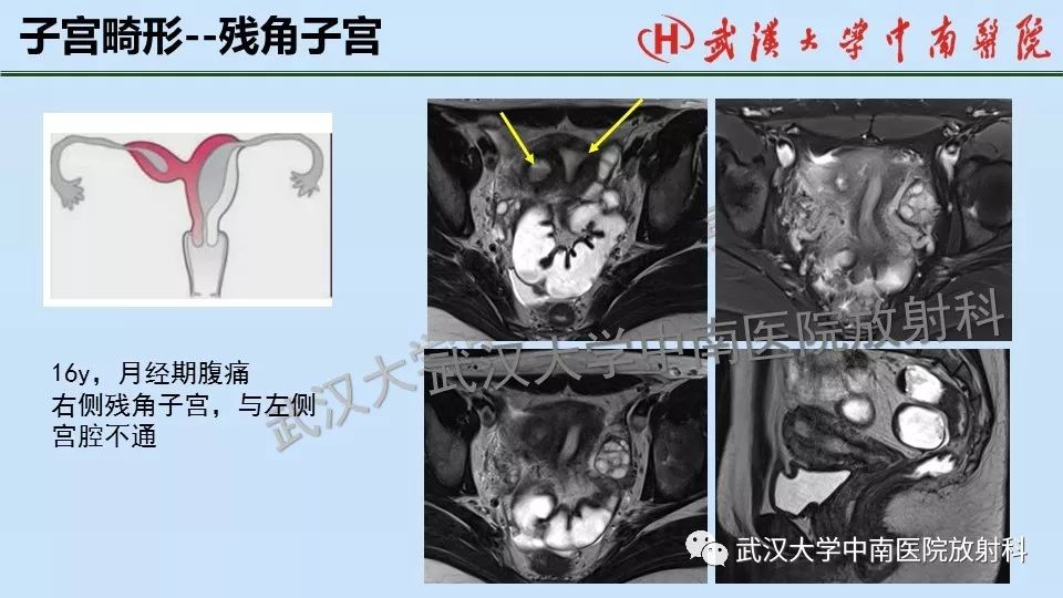 【PPT】女性生殖系统影像解剖及子宫常见疾病