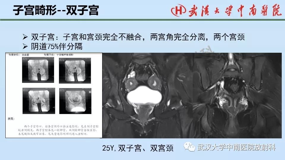 【PPT】女性生殖系统影像解剖及子宫常见疾病