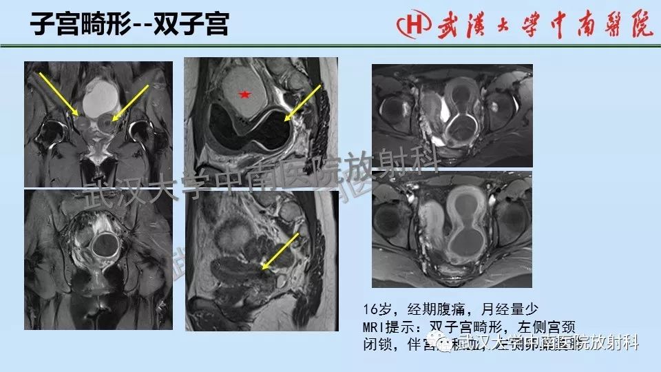 【PPT】女性生殖系统影像解剖及子宫常见疾病