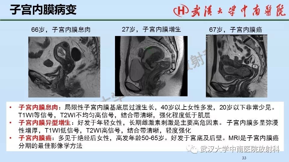 【PPT】女性生殖系统影像解剖及子宫常见疾病