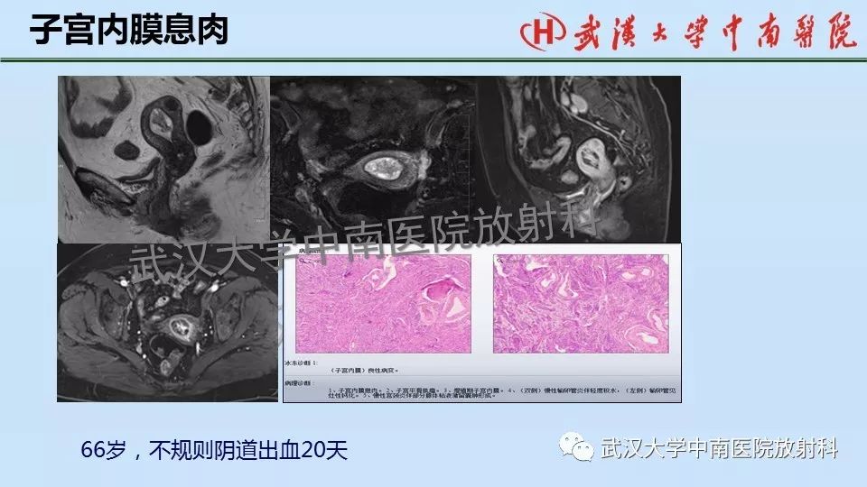 【PPT】女性生殖系统影像解剖及子宫常见疾病