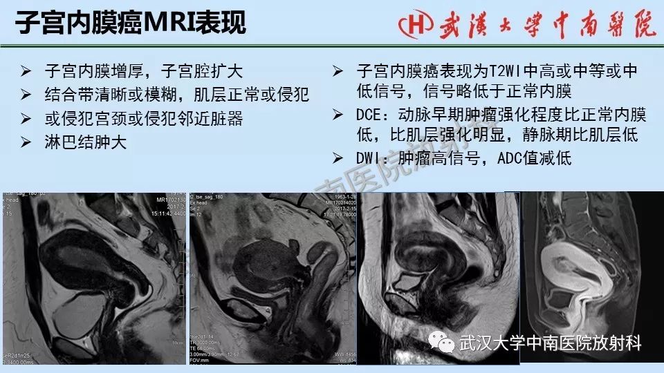 【PPT】女性生殖系统影像解剖及子宫常见疾病