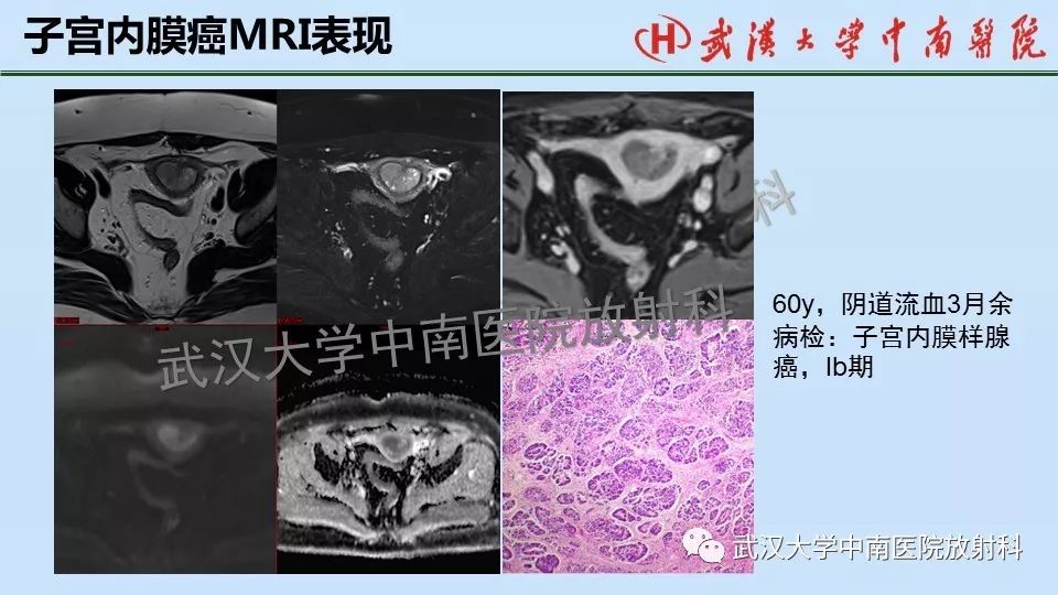 【PPT】女性生殖系统影像解剖及子宫常见疾病